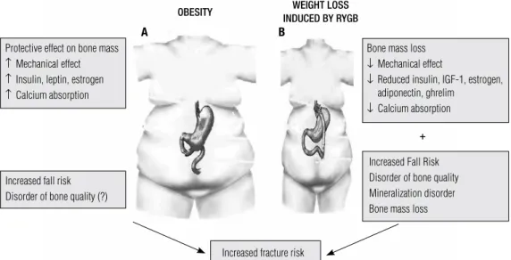Figure 1. (A) Pathophysiology of the increased fracture risk in obesity. (B) Pathophysiology of bone loss and of the increased fracture risk associated to  weight loss after bariatric surgery.