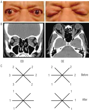 Figure 1. (A) Characteristic Graves’ ophtalmopathy; (B) Computed  tomography scans of the orbits; (C) Schematic representation of  extra-ocular muscle restriction.