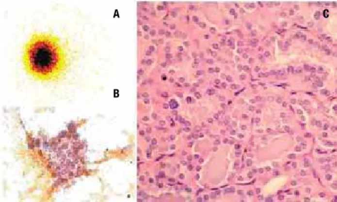 Figure 1.  (A) Thyroid  131 I-Scintigraphy shows a hyperfunctioning nodule in  the  right  lobe;  (B)  aspirate  smears  show  follicular  clusters  of  cells  with  large  and  pale  nuclei,  and  rare  intranuclear  inclusions;  (C)  histologic  sections