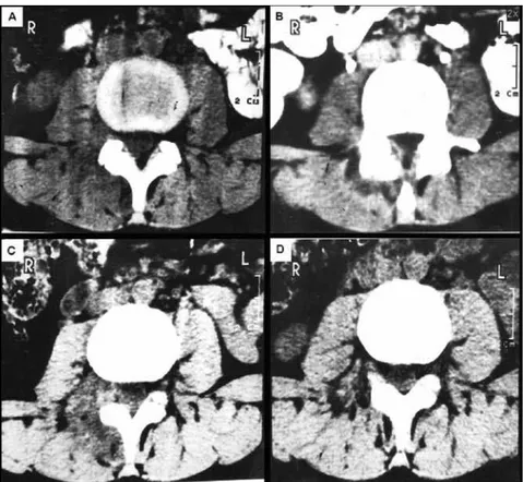 Figure 1. CT at L3-L4 level. A: right dorsal paraspinal and epidural collection before treatment; B: unusual fixation of the IV contrast; C: first month after the  treatment; D: CT normalization at the fourth month after the treatment.