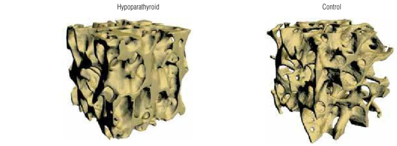 Figure 1B. 3-D µCT image of iliac crest biopsy in a representative hypoparathyroid subject (left) and a normal control (right).