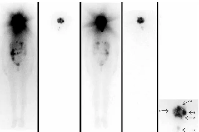 Figure 5. Whole-body scan using iodine 131 at diagnosis and after radioiodine therapy