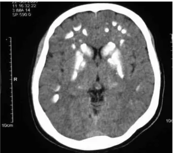 Figure 1. Calcium and phosphorus levels (mg/dl) in the patient with  pseudohypoparathyroidism that were presented at the mother-child  Hospital of Pernambuco (Instituto Materno Infantil de Pernambuco), Brazil.