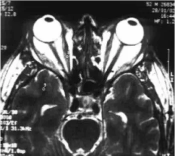 Figure 1. Shows US B-mode image of right rectus muscle in a TAO patient.