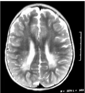 Figure 1. T1 weighted image − Discrete areas of hyposignal affecting  bilaterally the periventricular parieto-occipital white matter (cavitations).