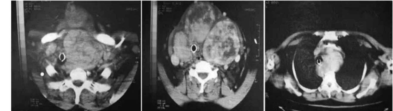 Figure 2. CT scan showing the large substernal goiter compressing and deviating the trachea.