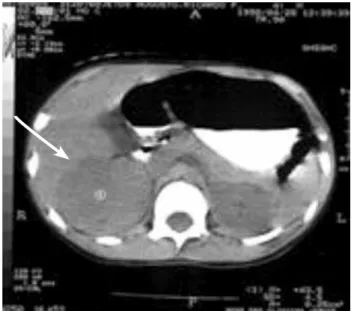 Figure 3. Abdominal computerized tomography showing a 8.0 cm mass in  the right adrenal gland.