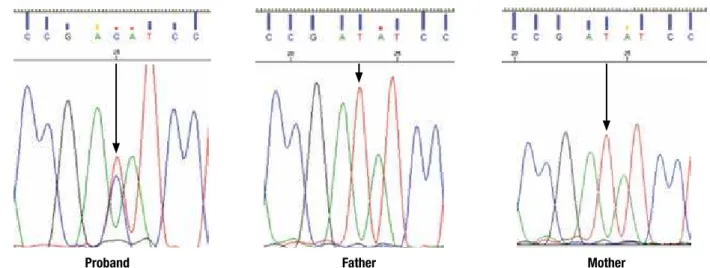 Figure 1. Reverse strand sequencing electropherogram showing the substitution of T by C at nucleotide 1491 (c.1491>G), resulting in the replacement  of isoleucine by methionine at codon 497 (p.I497M) of the GLUD1 gene in the proband