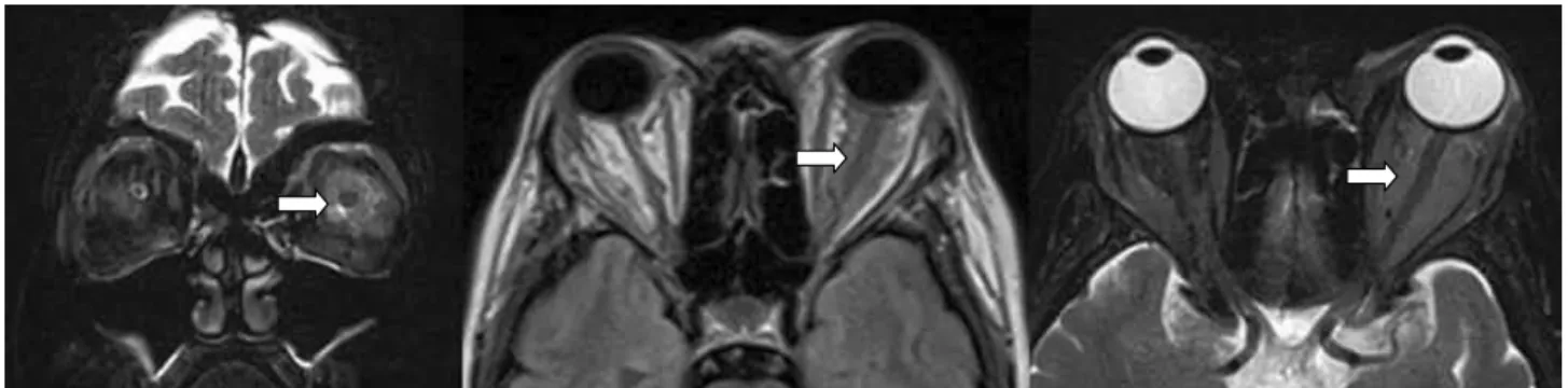 Figure 2. On T1 and T2-weighted magnetic resonance images. Note the mass in the left.