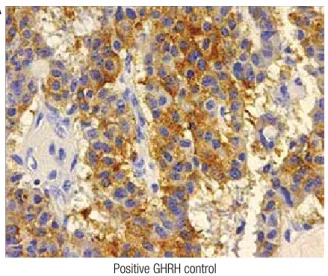 Figure 2. Immunohistochemistry for GHRH in a positive control tissue  sample from a pancreatic neuroendocrine tumor (A), and negative from  the pheochromocytoma of our patient (B).