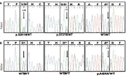 Figure 2. Electropherograms showing partial sequencing results of TSH receptor ( TSHR ) gene from the patient (A) and her mother (B)