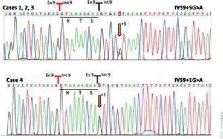Figure 2. Electropherograms of  WT1  exon 9 and intron 9 bordering  sequences. The splice sites for –KTS and +KTS isoforms are shown in red  and dark blue, respectively