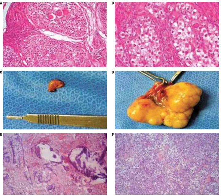 Figure 3. Gonadal morphology of case 1 (A: right dysgerminoma, H&amp;E, 100x; B: left dysgerminoma, H&amp;E, 400x); case 2 (C: dysgenetic gonad with  gonadoblastoma, macroscopy; D: gonadoblastoma with dysgerminoma, macroscopy); and case 4 (E: gonadoblastom