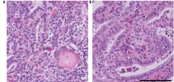 Figure 1. Histopathological slides of the resected differentiated PTC and lymph node metastasis