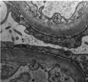 Figure 2. Electron microscopy showing diffuse effacement of the  epithelial cell (podocyte) foot processes (original magniication: 10,000x).