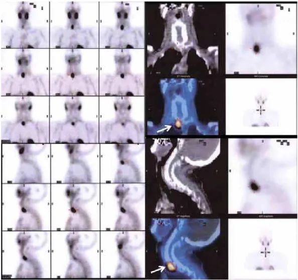 Figure 1. Parathyroid scintigraphy ( 99m Tc-Sestamibi) showing an area of high uptake near the sternal notch, to the right.