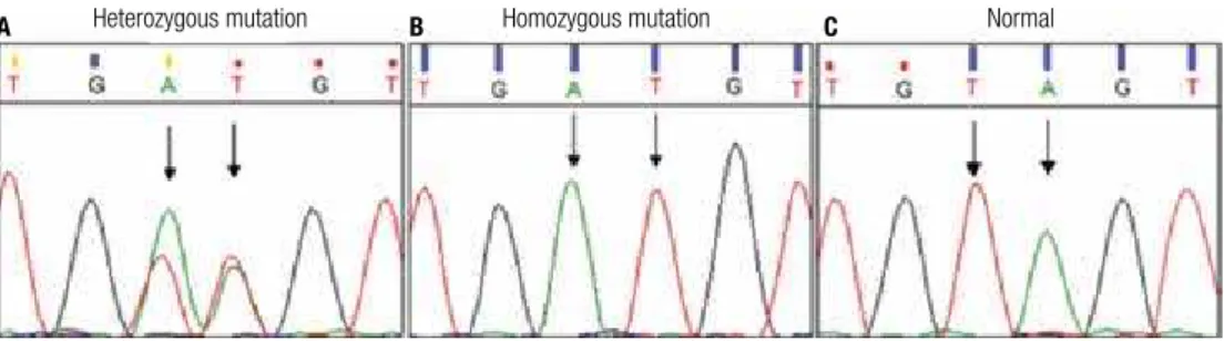 Figure 2. Sequence analysis of exon 2 of the  PTEN  gene in: (A) index case-DNA from peripheral leukocytes: T-to-A inversion – at position 159 and A-to-T  inversion at position 160 (arrows), leading to a heterozygous missense mutation (GTA – GAT) at codon 