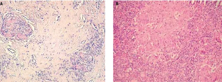 Figure 2. Thyroid sarcoidosis. HE x200. A. Diffused ibrosis between sarcoid granulomas (patient A); B