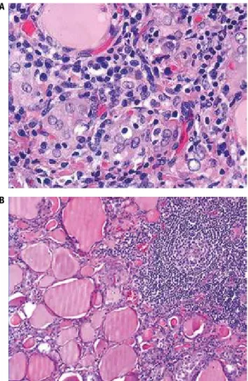 Figure 1 (A and B). H&amp;E section of HT. Note the lymphocyte iniltrate  assuming a follicular architecture and lymphoepithelial lesions.