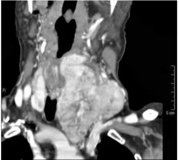 Figure 1. Left ptosis in Horner syndrome associated with thyroid carcinoma.