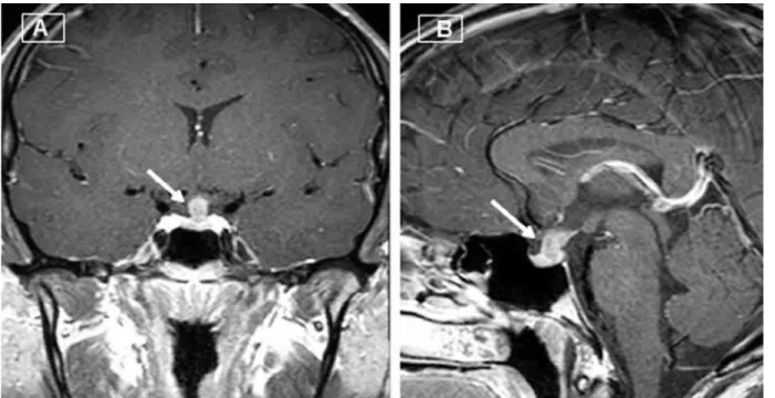 Figure 1. Suprasellar mass lesion reaching the posterior pituitary, leading to stalk thickening with normal sella (white arrow); T1- weighted images in  coronal (A) and sagittal (B) planes after paramagnetic contrast media administration are shown