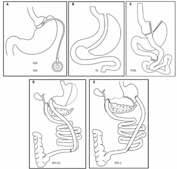 Figure 1. Usual bariatricoperations: ( A ) adjustable gastric banding (AGB), ( B ) sleeve gastrectomy (SG), ( C ) Roux-en-Y gastric bypass (RYGB), ( D ) BPD/
