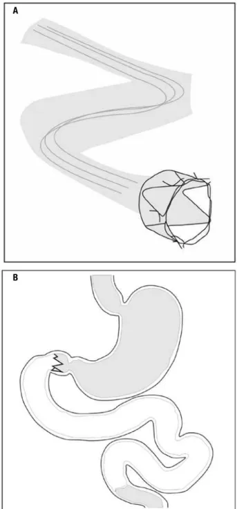 Figure 2. Endoscopic device for temporary duodenal exclusion  (EndoBarrier) consisting of a metal anchoring system with tiny hooks and  a sleeve made of a polymer 60 cm long ( A ) which prevents contact of food  with the biliary and pancreatic secretions u