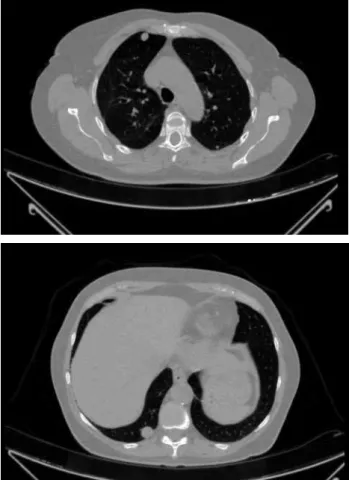 Table 1. Bone mineral density recovery after removal of lung metastasis