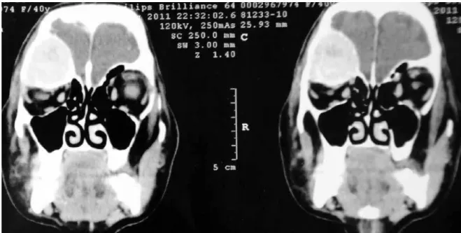 Figure 3. Computed tomography: supraorbital expansive lesion suggestive of brown tumor.