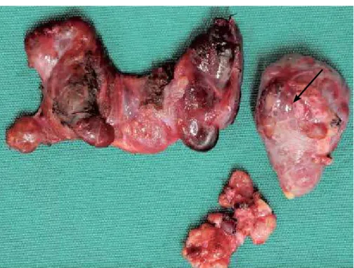 Figure 5.  En bloc resection: nodular thyroid, parathyroid (arrow), and lymph-nodes.