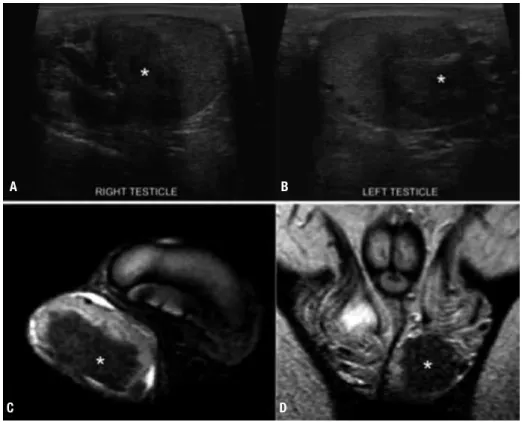 Figure 2. Testicular adrenal rest tumor (TART) in a 14 year-old male, with simple virilizing congenital adrenal hyperplasia