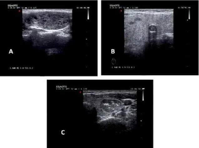 Figure 1. Thyroid nodule calciications detected in ultrasonography. (A) Microcalciication, (B) peripheral (eggshell) macrocalciication, (C) parenchymal  (internal) macrocalciication.