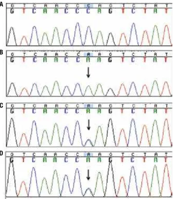 Figure 1. Electropherogram of partial nucleotide sequence of the exon 4  of the  HSD3B2  gene