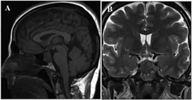 Figure 1. Magnetic resonance imaging at presentation: sagittal (A) and  coronal (B) views.