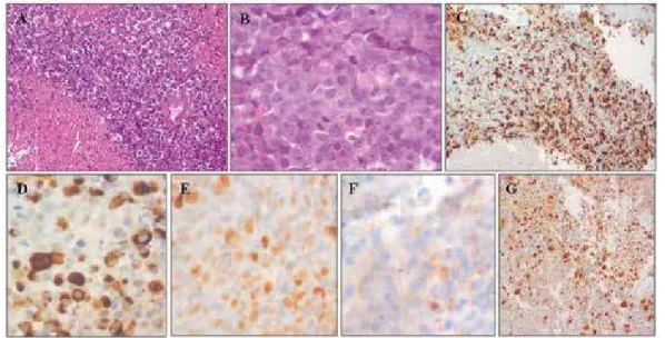 Figure 2. Pituitary carcinoma photomicrographs: A: hypercellular neoplasia with extensive necrotic areas (hematoxylin-eosin stain, 20x)