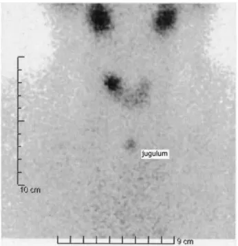Figure 4.  99m Tc-Pertechnetate thyroid scintigraphy revealed an avid tracer  uptake in the right lobe, corresponding to the nodular lesion demonstrated  by the US consistent with an AFTN.
