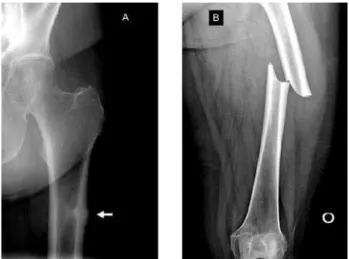 Figure 1. X-rays showing an impending femoral shaft fracture (A) and a  representative “atypical” diaphyseal femoral fracture with lateral cortical  thickening and a lucency appearing like a “beak” and (B) with thickened  cortices and a medial spike