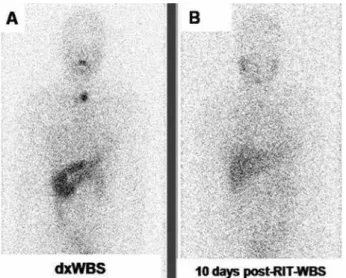 Figure 2. An example of a total stunning. (A)  131 I-iodide dxWBS shows  increased cervical uptake