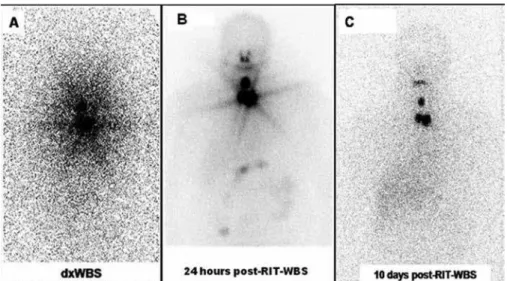 Figure 3. An example of progressive washout in a young female patient. (A)  131 I-iodide dxWBS depicts markedly increased cervical uptake