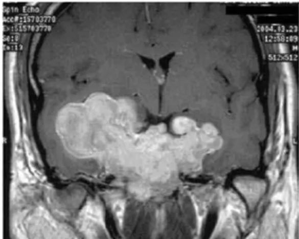 Figure 8. Giant invasive pituitary prolactinoma with falsely low serum PRL  (103 ng/mL.) due to the hook effect
