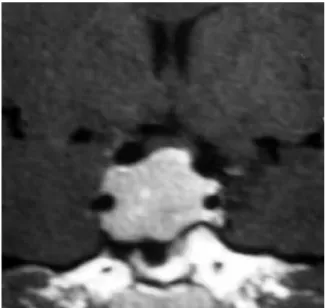 Figure 1. Huge sellar mass (conirmed to be a non-functioning pituitary  adenoma) in a patient chronically treated with haloperidol who presented  with mild elevation of prolactin
