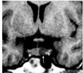 Figure 3. Microprolactinoma in a patient with macroprolactinemia (arrow). 