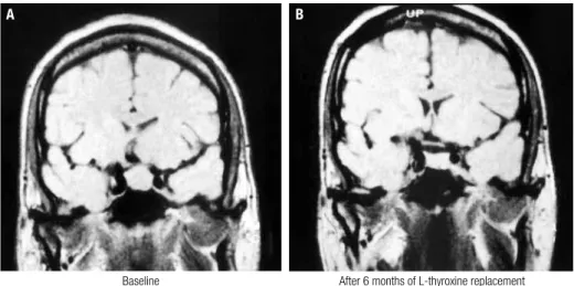 Figure 5. Diffuse pituitary enlargement in a patient with primary hypothyroidism-induced hyperprolactinemia,  before (A) and after (B) L-thyroxine replacement.