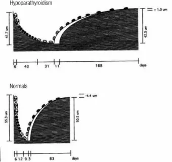 Figure 1. Reconstructed remodeling cycles in cancellous bone in  hypoparathyroid (upper) and normal (lower) subjects