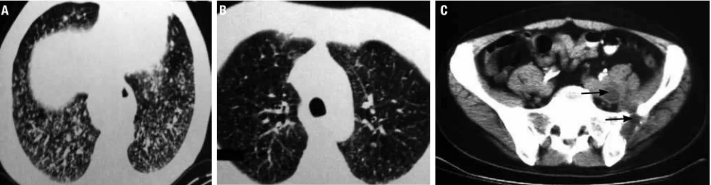 Figure 3. 53-year-old male patient with dedifferentiated papillary thyroid carcinoma metastatic to lung and bones