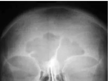 Figure 1. Plain X-Ray shown “salt-and-pepper” appearance of the skull  in a 38 years old female patient OFC.