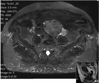 Figure 1. Pelvic MRI revealed a solid nodule of 29.5 x 22.8 mm in the left  ovary.