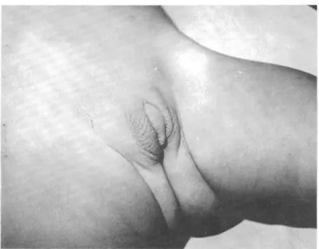 Figure 6 - Patient (case 1) with ambiguous genitalia at the time of the first consultation, note clitoromegaly and rugated labioscrotal folds.