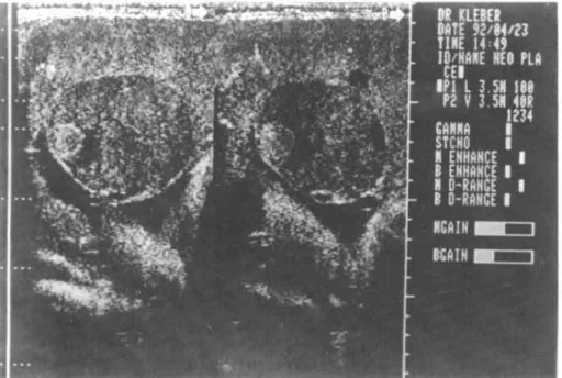 FIGURE 1 - U ltrasonography show s a w ell-delineated hypoechoic im age w ith a sm all echogenic round area at the left.