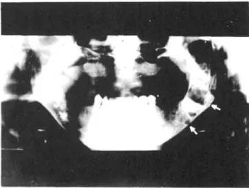 Figure 2: The arrow shows calcification areas in the falx cerebri